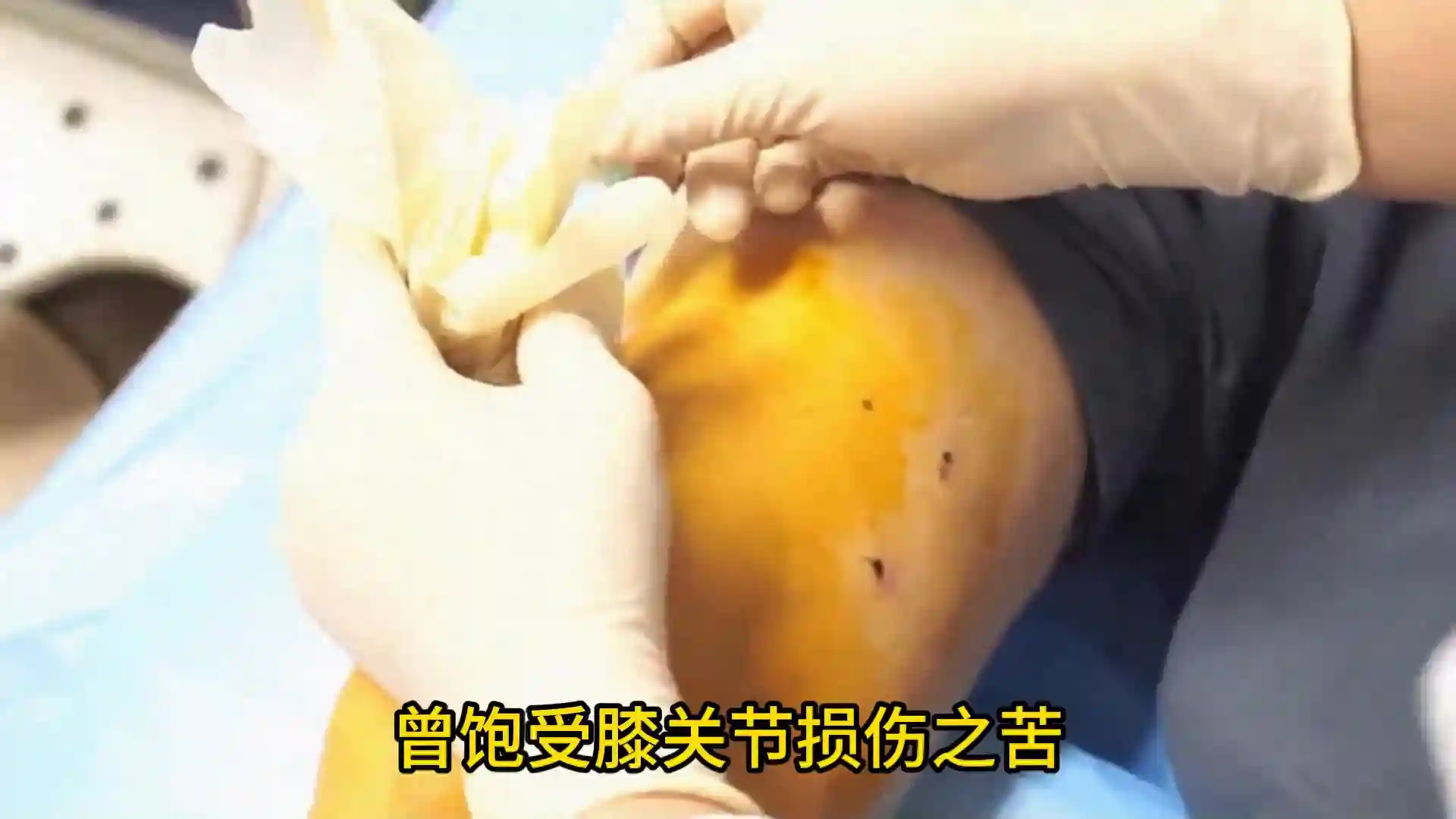 三个真实案例：干细胞替代膝关节手术，让60岁以上患者重拾健康
